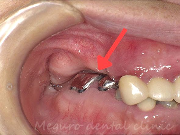 下アゴの奥歯が伸びて、上アゴの歯肉に咬みこんでいます。超難症例です