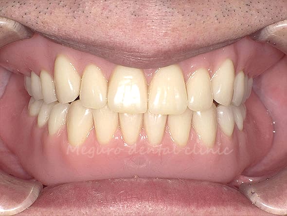 高機能部分入れ歯の症例