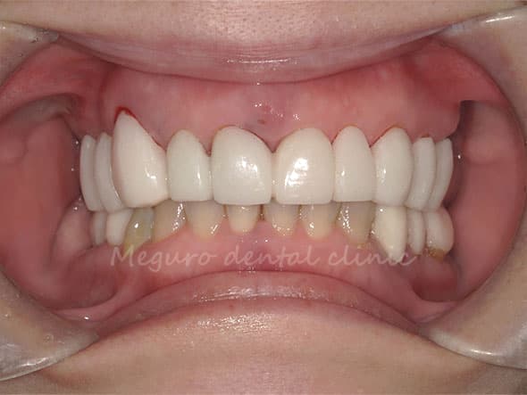 ベテラン技工士による仮の歯の製作、修正がその場で可能になります。