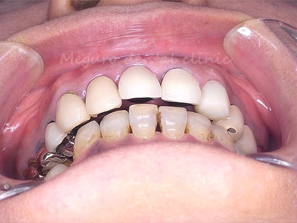 他院のセラミック冠です。奥歯が噛んでいるのに前歯の裏側に隙間があります。咬み合わせがズレています。患者様は、気づいていませんでした。よくある顎関節症の原因です
