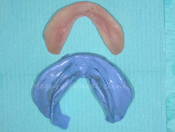 青が2回目の歯型。上が他院の入れ歯です