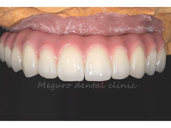 完成・正面 歯の色は患者様のご希望に合わせて変更可能です