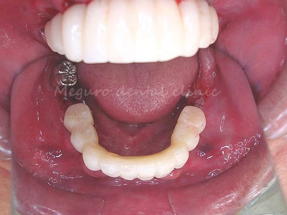 手術当日の仮の歯