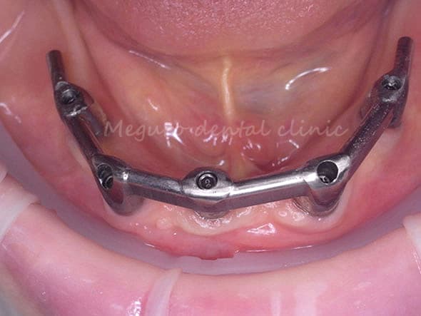 入れ歯を固定する精密な維持装置