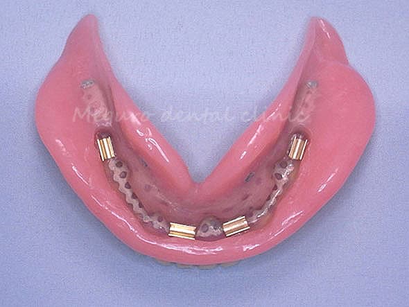 入れ歯の裏側の維持装置
