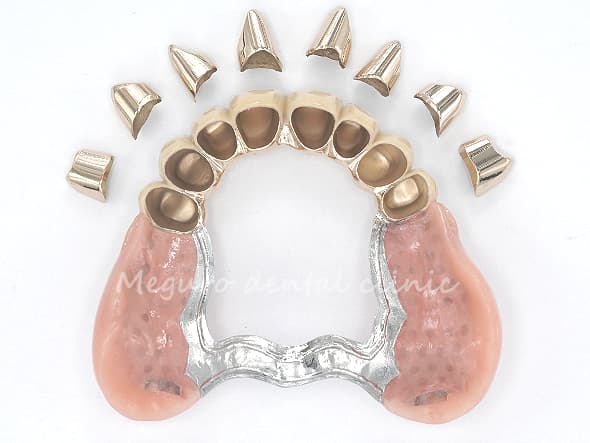 内側の金属冠と、外側の部分入れ歯です