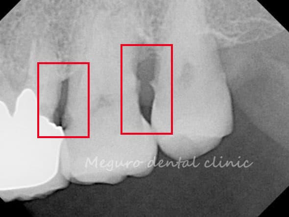 中等度～重度の歯周病の歯
