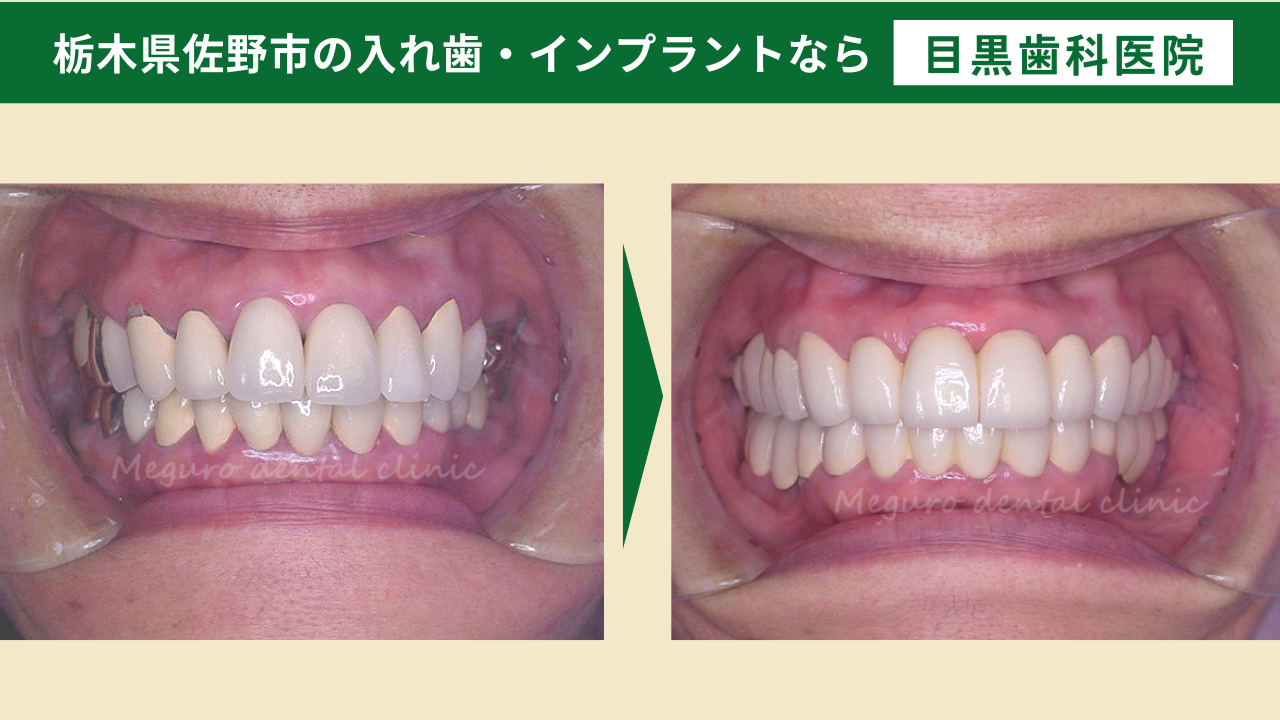 見た目もキレイで何でも噛める入れ歯治療