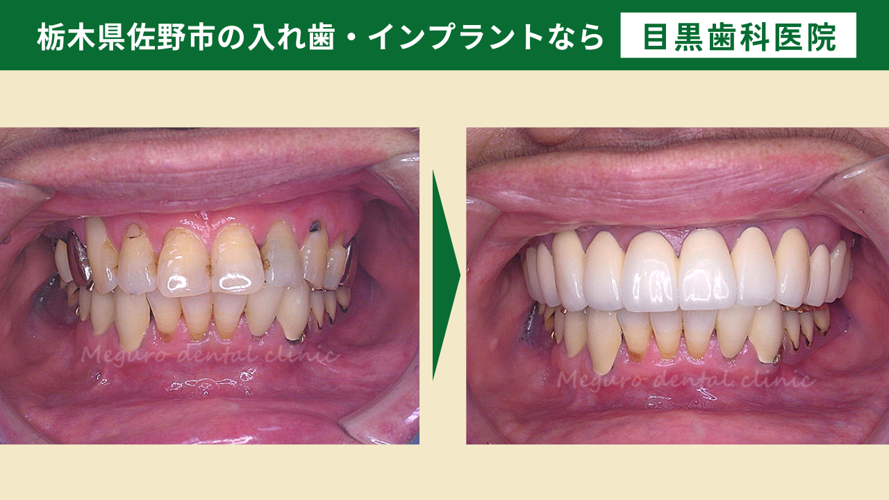 誰にも気づかれない入れ歯を知っていますか？