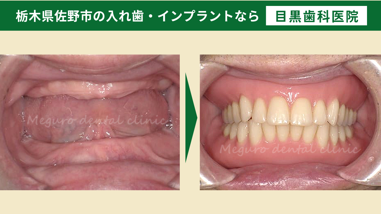 失敗しない総入れ歯