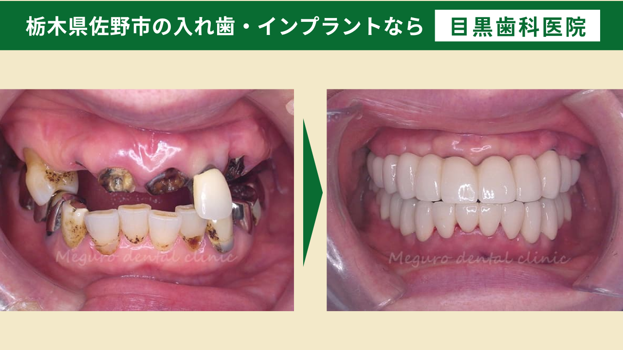 骨が薄いから…とインプラントを諦めないでください