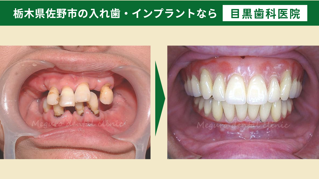 オールオン４で総入れ歯から固定式の歯へ